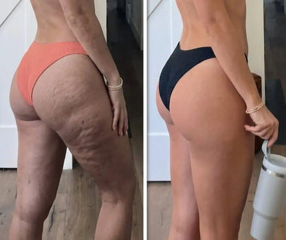 Benevital™ Crema Anticelulítica Profesional
